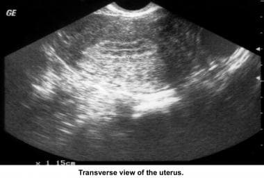 Infertility. Sonogram: Transverse view of the uter