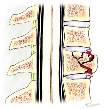 Osteoporosis and Massage: Etiology, Signs & Safety