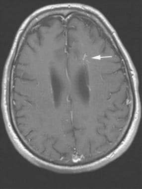 Brain, venous vascular malformation. Axial postcon