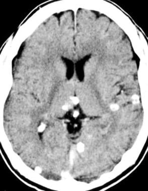 Nonenhanced CT scan of the brain demonstrates the 