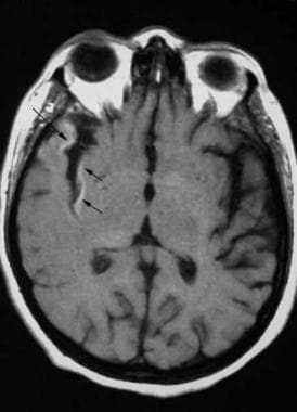 Axial nonenhanced T1-weighted image shows cortical
