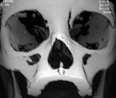Computed tomography scan in a child with a high-im