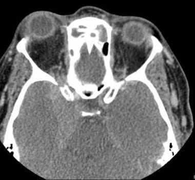 CT orbital fissure and MRI orbital fissures: Axial