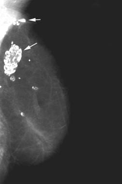 Mediolateral oblique mammogram in a patient 3 year