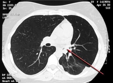 Asthma. High-resolution CT scan of the thorax obta