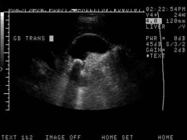 Cholelithiasis. Ultrasound image obtained with a 4