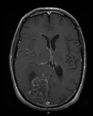 MRI, T1-weighted axial image, post gadolinium. A 6