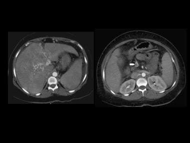 Contrast-enhanced axial CT depicts cavernous trans