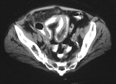 An enhanced axial CT scan at the level of the righ