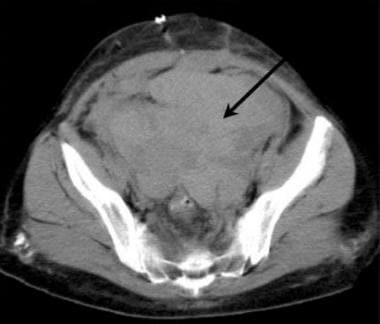 Axial CT of the pelvis in a potential renal transp