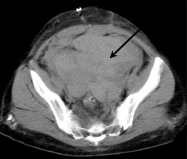 Axial CT of the pelvis in a potential renal transp