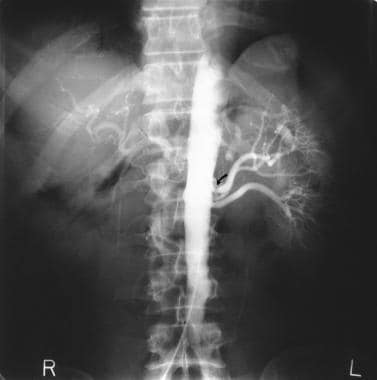 Renal artery stenosis/renovascular hypertension. F