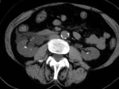 Axial nonenhanced CT image at the level of the kid