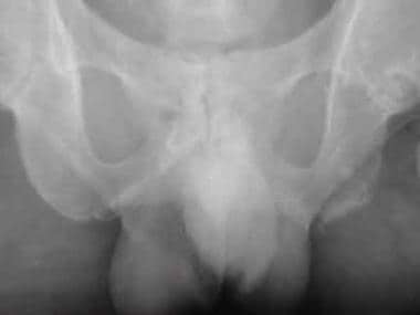 Pelvic enthesopathy. Frontal radiograph shows ill-