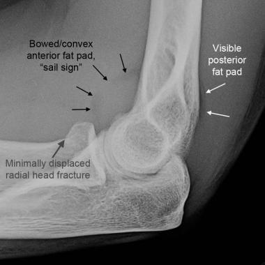 Elbow, fractures and dislocations. Elbow effusion 