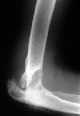 Neuropathic arthropathy (Charcot joint). Lateral v