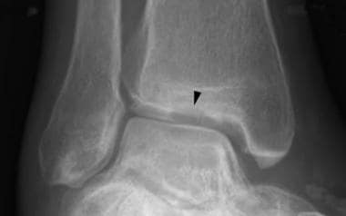 Mortise view of the ankle reveals lucency in the c