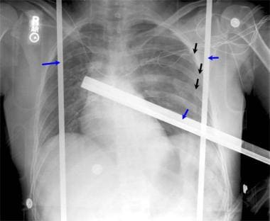 Anteroposterior (AP) supine chest radiograph that