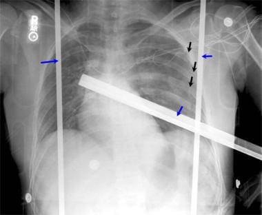 Anteroposterior (AP) supine chest radiograph that 