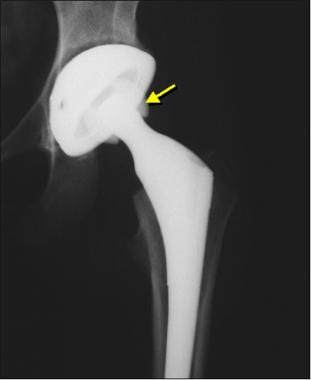 Image from a patient who had a normal total hip ar