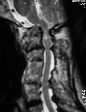 Sagittal T2-weighted MRI of the cervical spine in 