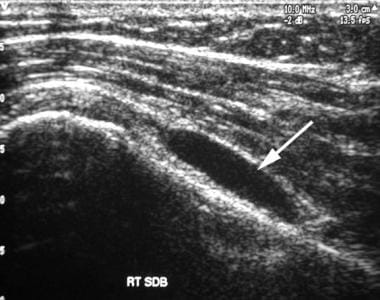 Shoulder, rotator cuff injury (ultrasonography). L