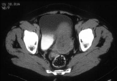 A 64-year-old woman with poorly differentiated end