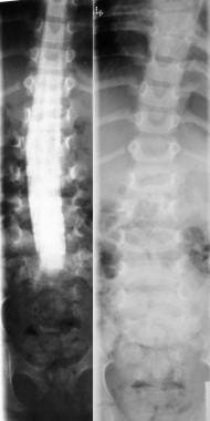 Right, plain radiograph of the lumbar spine shows 
