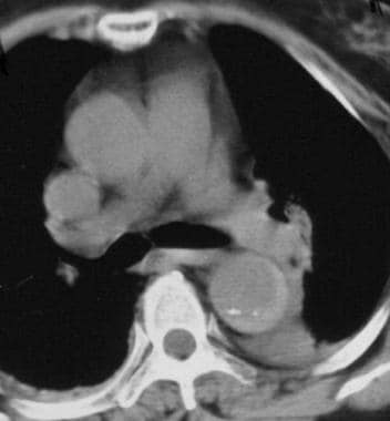 Nonenhanced CT scan of the chest demonstrates a ty