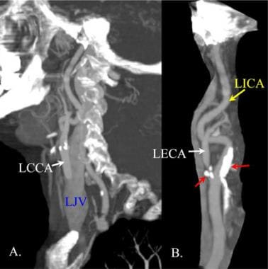 CT和CT血管造影在负荷左侧的病人