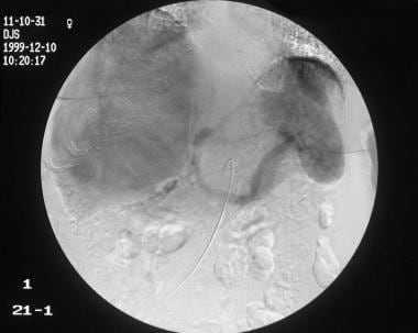 Portal venous phase of a celiac-axis angiogram (sa