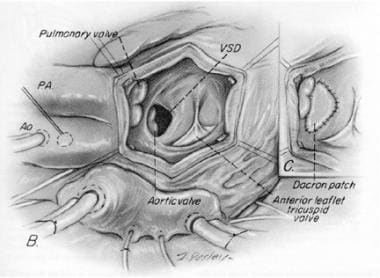 Ventricular Septal Defect Surgery in the Pediatric