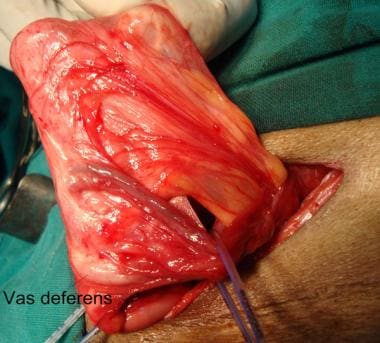 Open inguinal hernia repair. Voluminous indirect h