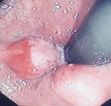 Grade II internal hemorrhoids