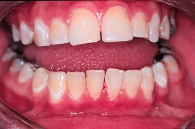 Intraoral view of a 14-year-old adolescent girl wi