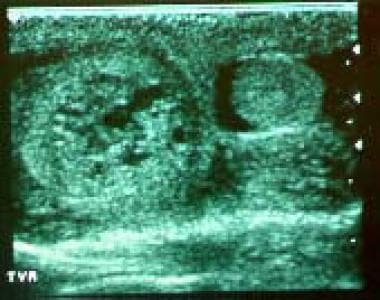Ultrasonogram in infant revealing heterogeneous in