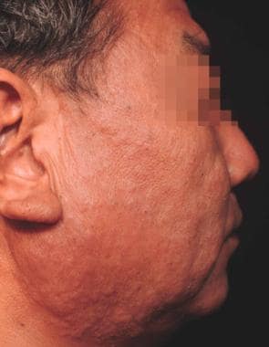 A 51-year-old Japanese man without a concomitant H