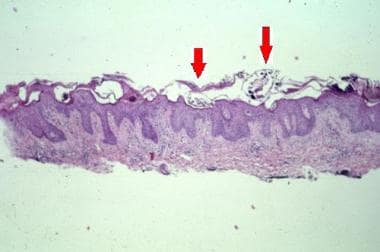 In crusted scabies, sections show multiple mites (