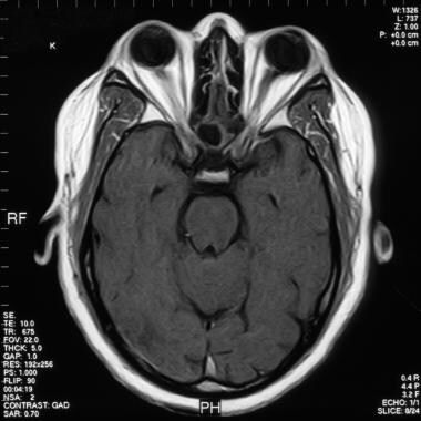 一个有sarcoid的37岁男子的大脑MRI