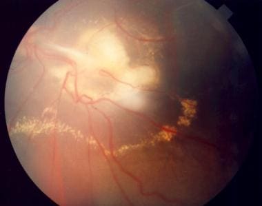 serous retinal detachment oct