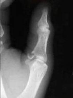 Lateral radiograph displaying gamekeeper's fractur