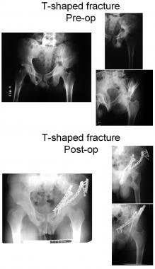 T-shaped fracture (note the use of the anterior-to