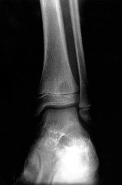Anteroposterior radiograph of the distal tibia. Th