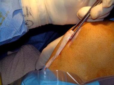 Surgical reconstruction most commonly uses the pat