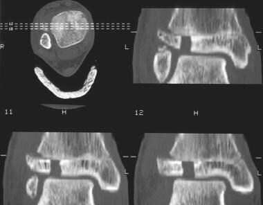 Growth plate (physeal) fractures. Multiple compute