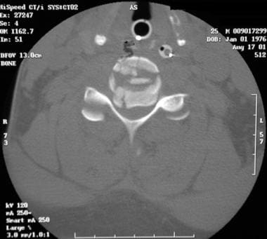 Axial CT scan of C5 burst fracture. 