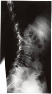 Spinal infections. Patient B (47-year-old woman) p