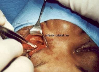 Operative photo of fracture repair via transconjun