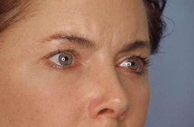 Subperiosteal facelift. Before. Close-up three qua