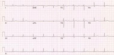 junctional bradycardia rhythm strip